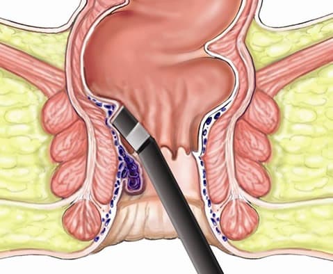 hemerrhoid treatment